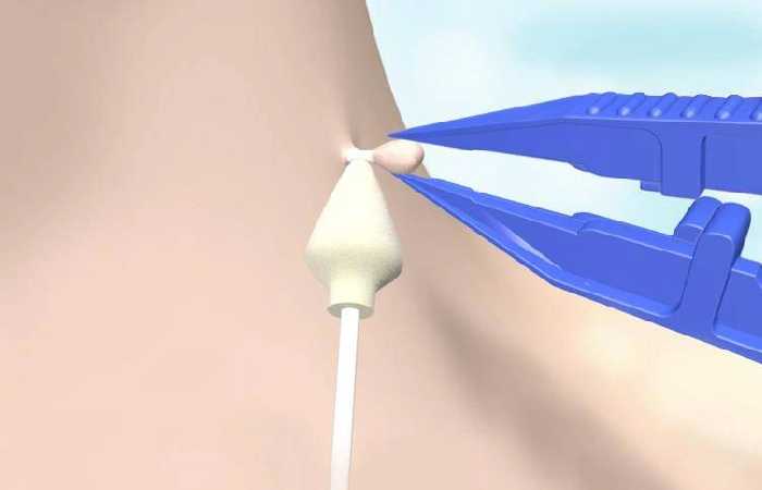 Cryotag Skin Tag Remover